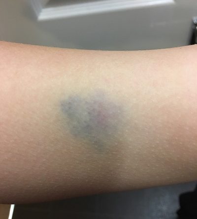 Bullying at Bristol School